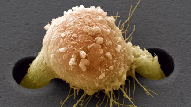 Desarrollan dispositivo implantable para evitar reaparición del cáncer