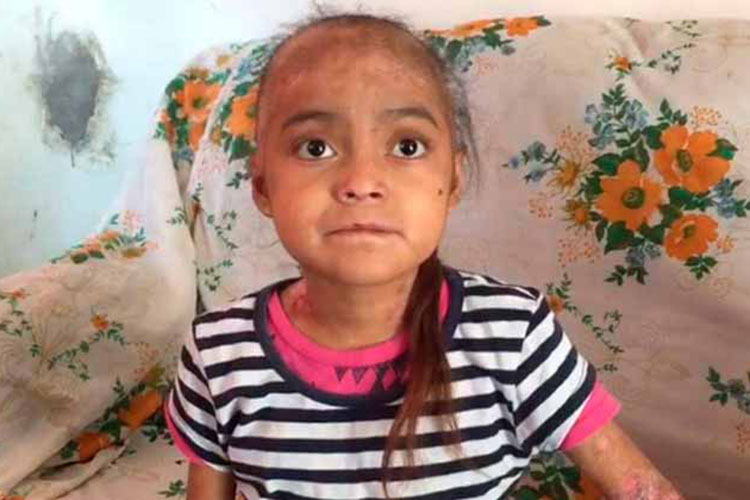Cumplirán sueño de jovencita que padece piel de mariposa