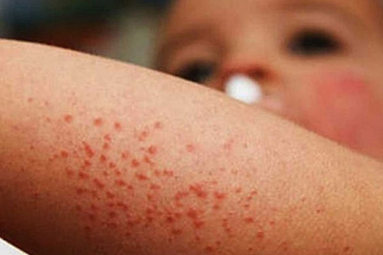 Cierran 12 escuelas en Oaxaca por virus coxsackie