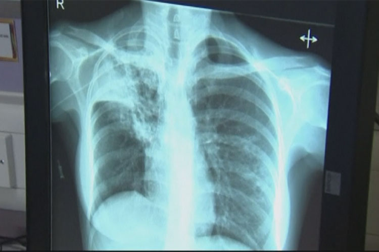 Registra Tamaulipas 400 casos de Tuberculosis