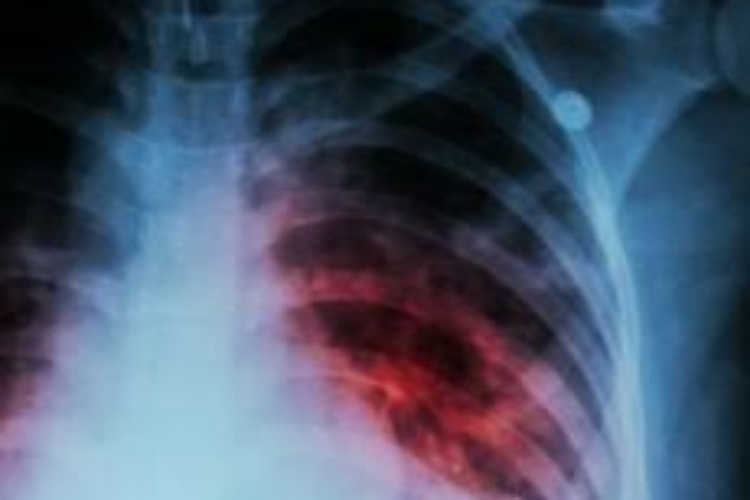 Lista SSA ante posibles brotes de Tuberculosis e Influenza