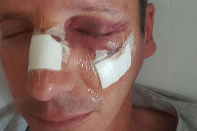 Banderillero Reyes Mendoza sufre severa lesión ocular y facial