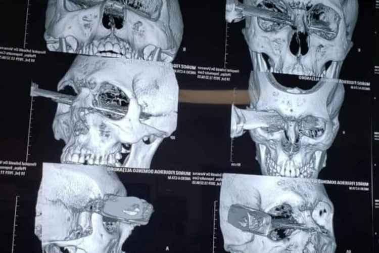 Perdió el ojo pero está fuera de peligro: Hospital
