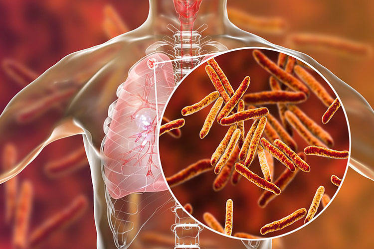 Diagnostican a 12 migrantes con Tuberculosis en la zona sur