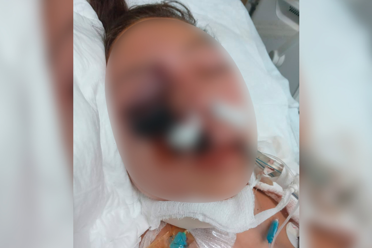 Enferma de “hongo negro” menor de 15 años de edad