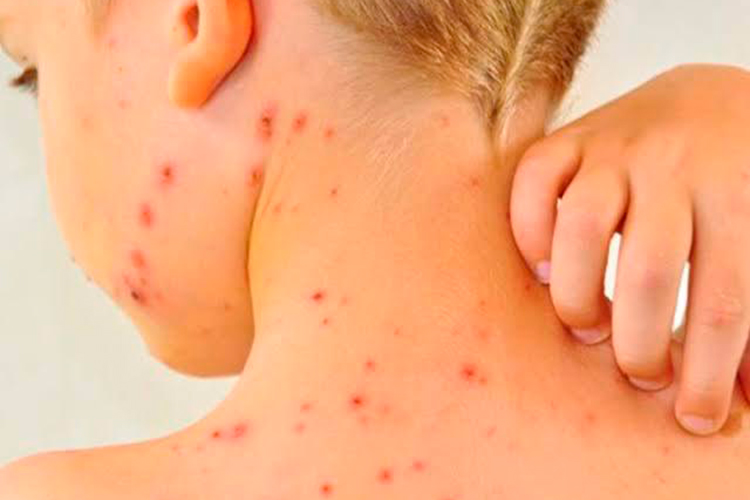 Brote de sarampión en campos menonitas enciende alertas sanitarias